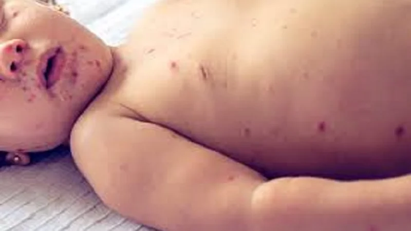 Five children died of measles on Sunday in Chandru Meo village of Tando Allahyar.