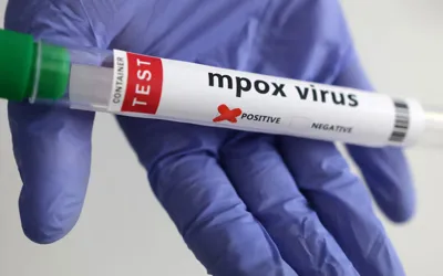 Smart lockdown imposed in Jamrud amid Mpox outbreak