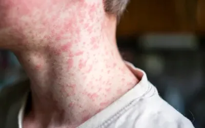 Measles cases surge in Karachi and Sindh