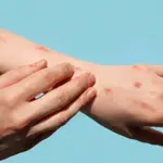 Mpox case reported in Karachi