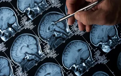New AI tool detects brain tumors in minutes instead of days