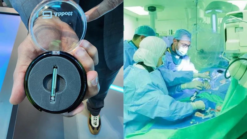 UAE: Matchstick-sized pacemaker requires no surgery, lasts for 25 years
