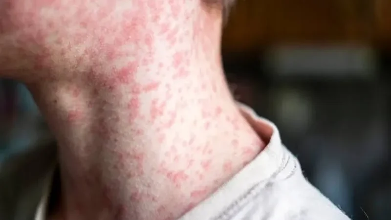 Pennsylvania faces measles surge as cases soar to 903