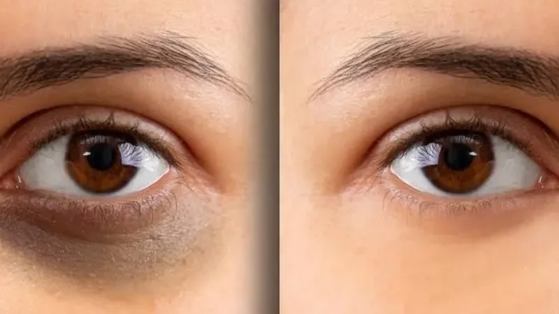 Simple tips for reducing dark circles under the eyes - almond oil, Cold tea bags, Cucumber slices, Dark circles, under the eyes