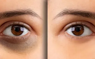 Simple tips for reducing dark circles under the eyes
