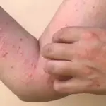 Pakistan confirms its first monkeypox case of 2024