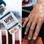 Nigeria reports 39 new Mpox cases this year