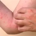 NIH issues health advisory about Chikungunya