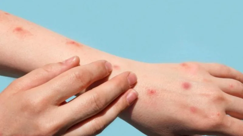 One death from Monkeypox reported in Pakistan: Dr Mukhtar