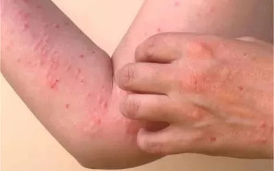 Chikungunya cases rate increase in Karachi