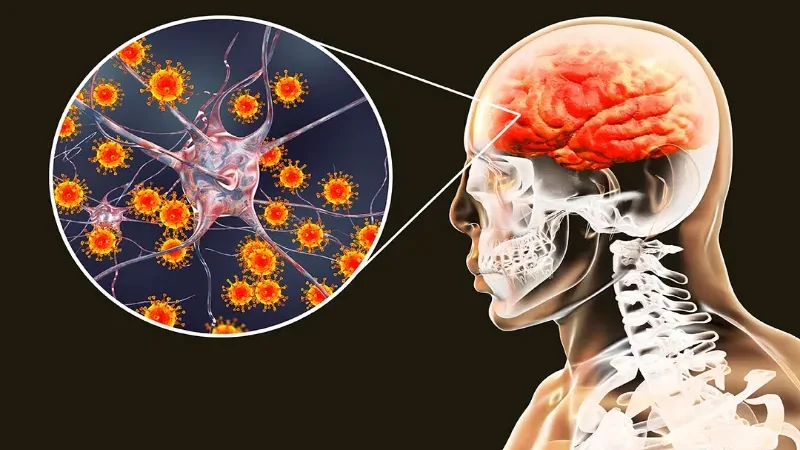 Encephalitis