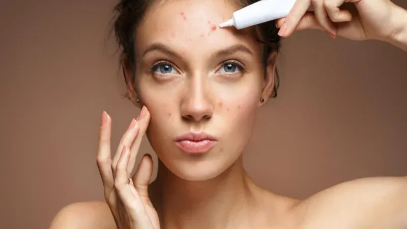 ‘Acne’ breakouts