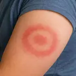 Lyme disease: symptoms, causes and treatment