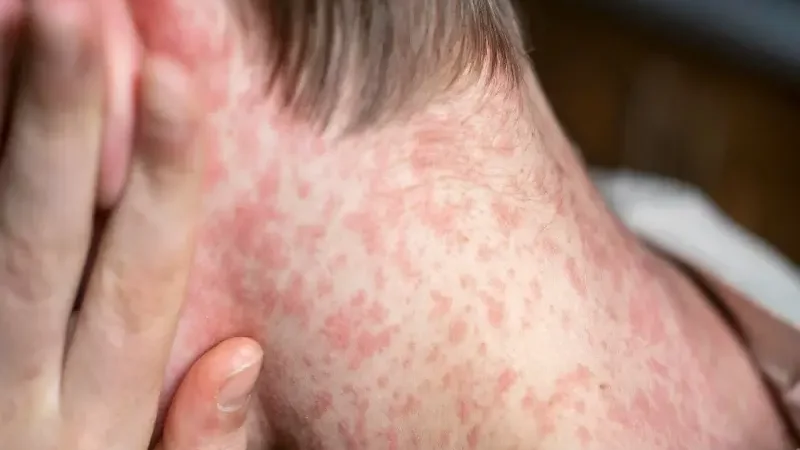 1695 suspected measles cases reported in Punjab