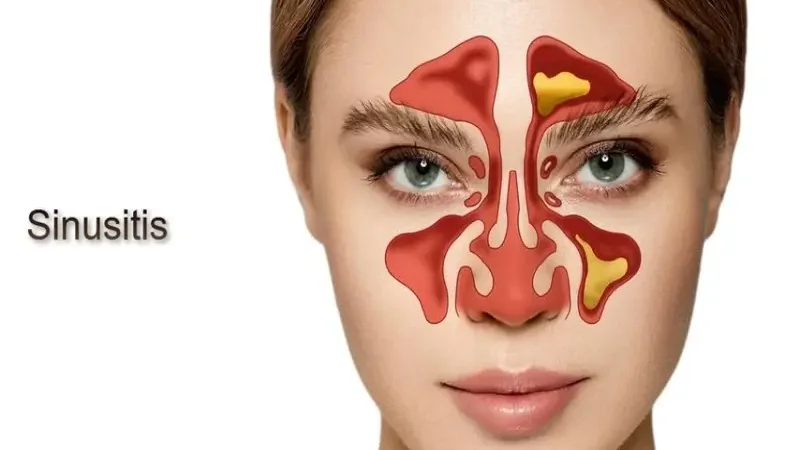 Sinus Infection (Sinusitis): Causes, Symptoms & Treatment