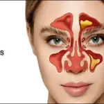 Sinus Infection (Sinusitis): Causes, Symptoms & Treatment