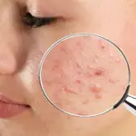 Acne: Types, Causes, Treatment & Prevention