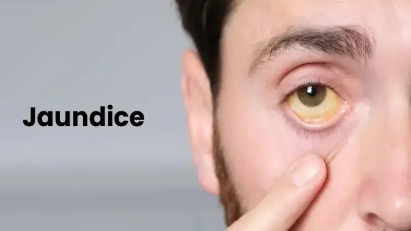 What is Jaundice? Symptoms, causes, treatment, prevention