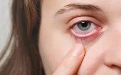 Dry eyes: Symptoms, causes, treatment, prevention