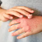 Here's everything you need to know about Eczema