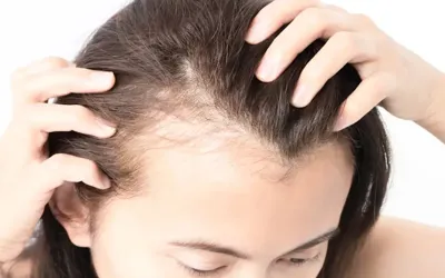 Five tips to care for thinning hair