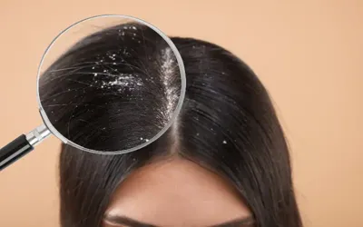 Here's how can you treat dandruff