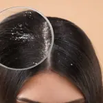 Here's how can you treat dandruff