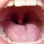 What are tonsil stones? Symptoms, causes, diagnosis, treatment, and prevention