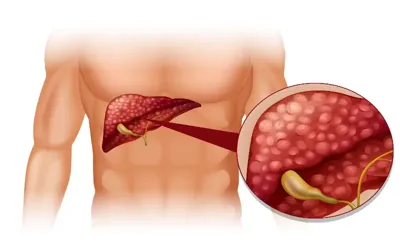 Gallbladder: Symptoms, causes, diagnosis, treatment, and prevention