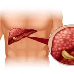 Gallbladder: Symptoms, causes, diagnosis, treatment, and prevention