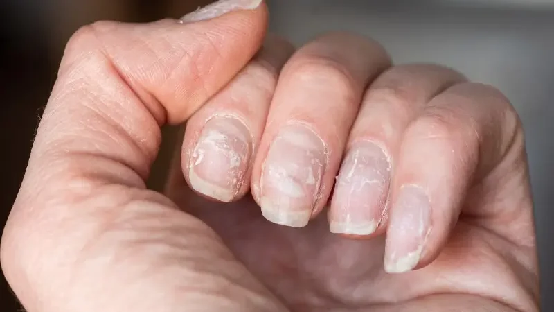 Signs of unhealthy nails you shouldn’t ignore
