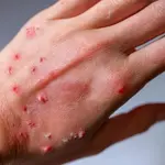 Mpox case confirmed in Karachi: Alert issued by Sindh