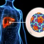Hepatitis A: Symptoms, causes, diagnosis, treatment, and prevention