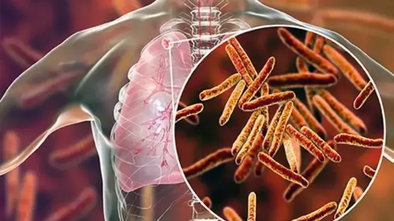 More than 93,000 children are affected by tuberculosis each year in Pakistan