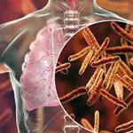 More than 93,000 children are affected by tuberculosis each year in Pakistan