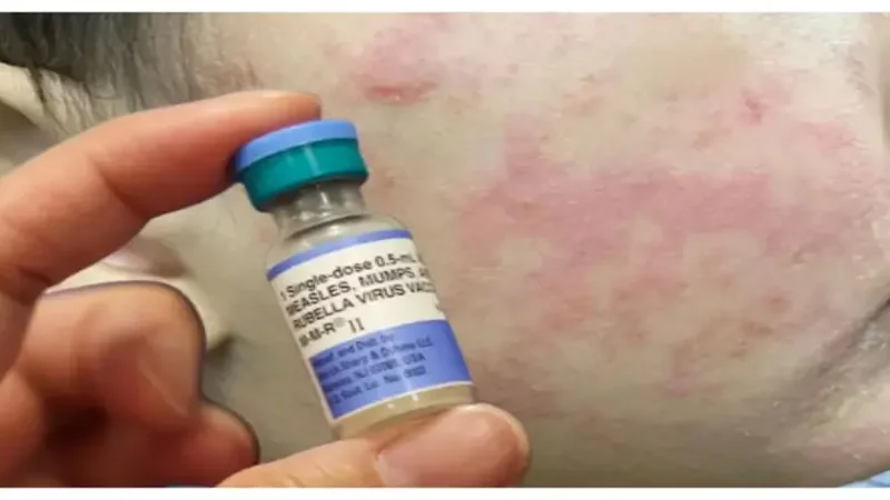 South Carolina Health Officials Warn of Growing Measles Outbreak