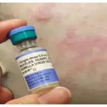 South Carolina Health Officials Warn of Growing Measles Outbreak